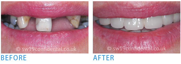 Home and Zoom office teeth whitening - Before after 2