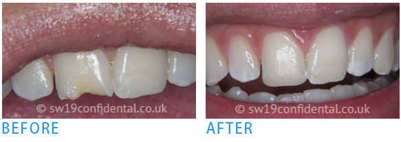White-Fillings - Before after