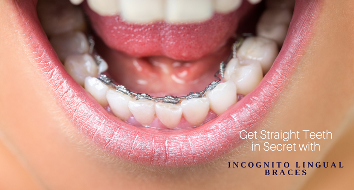 https://www.sw19confidental.co.uk/wp-content/uploads/2021/08/1511958938get-straight-teeth-in-secret-with-incognito-lingual-braces.png