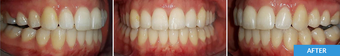 Overlycrowded After 8 - Confidental Dental Clinic Smile Gallery