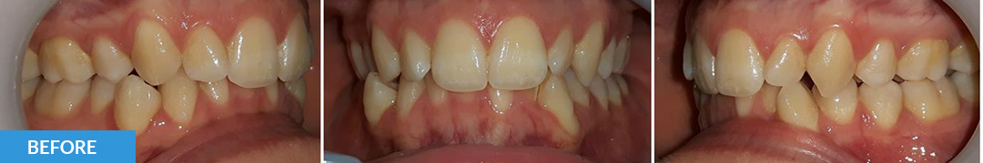 Overlycrowded Before 16 - Confidental Dental Clinic Smile Gallery