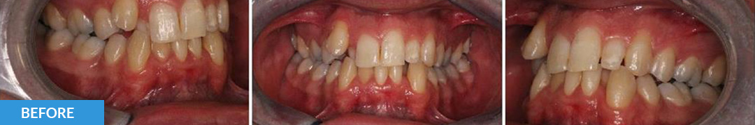 Overlycrowded Before 2 - Confidental Dental Clinic Smile Gallery