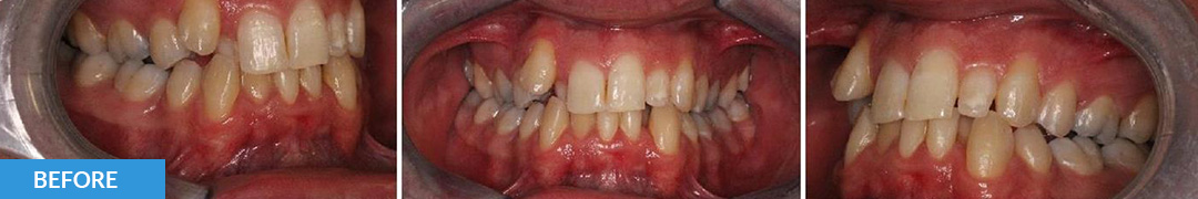 Overlycrowded Before 5 - Confidental Dental Clinic Smile Gallery