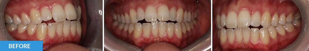 Overlycrowded Before 8 - Confidental Dental Clinic Smile Gallery