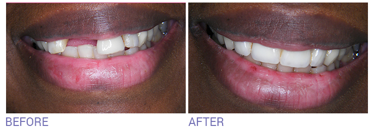 Teeth Whitening in Wimbledon