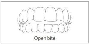 Openbite Teeth Treatment in Wimbledon