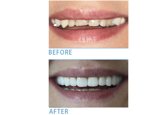 Teeth Whitening in Wimbledon