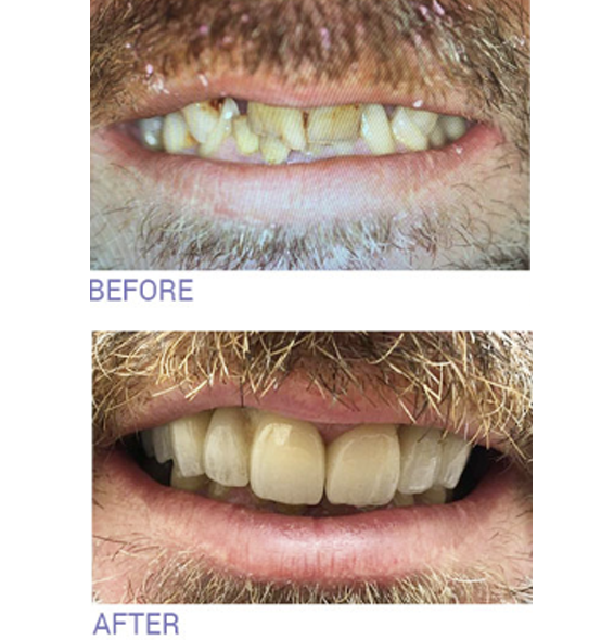 Teeth Whitening in Wimbledon