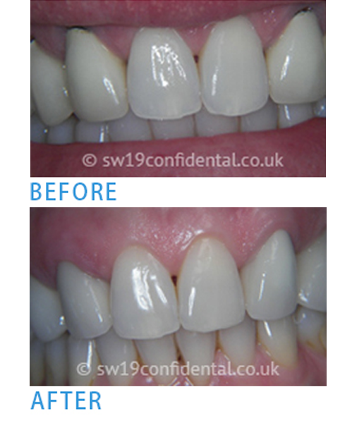 Teeth Whitening in Wimbledon