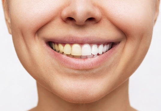 Teeth Whitening in Wimbledon