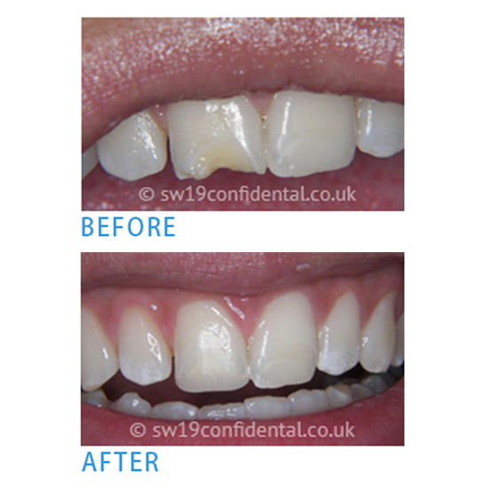 Teeth Whitening in Wimbledon