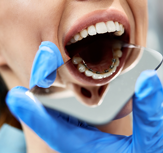 Teeth Whitening in Wimbledon