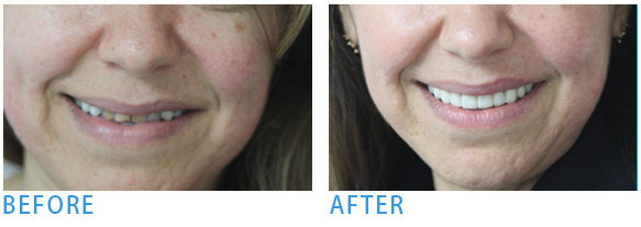 Home and Zoom office teeth whitening - Before after 5