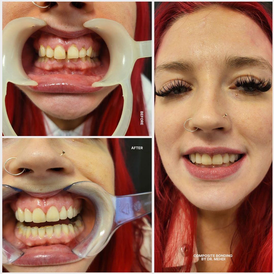 Bridge for the same doctor - before and after