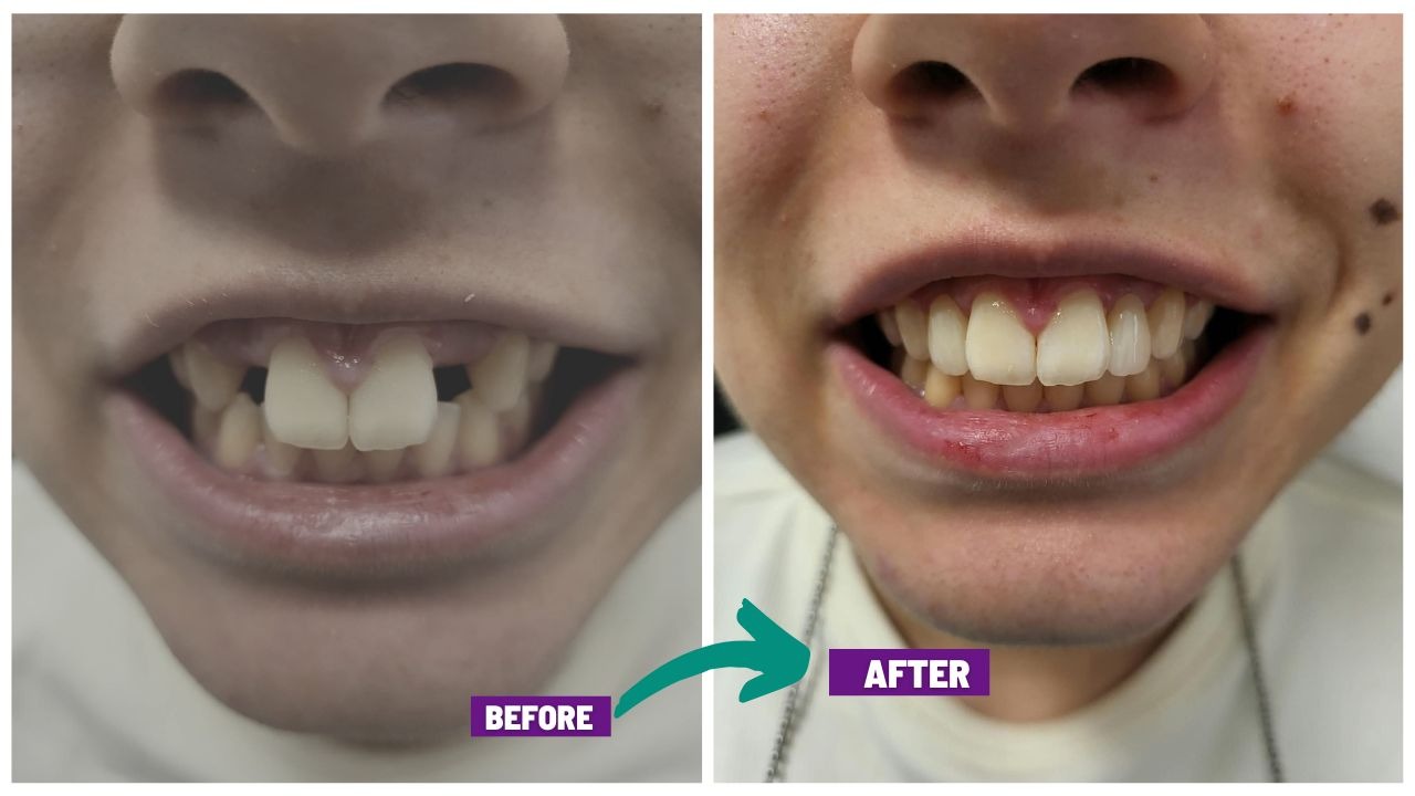 Composite bonding before After Dr mahadi